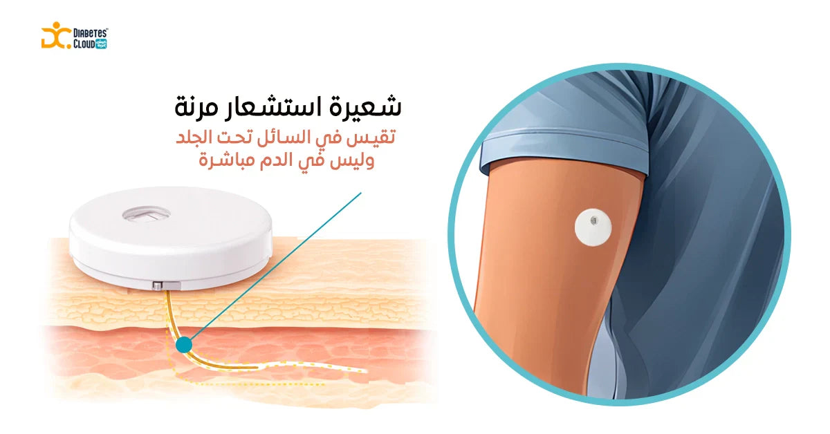 how linx sensor measure glucose in body